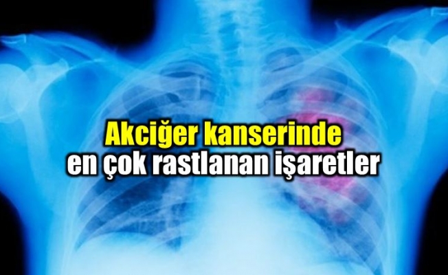Akciğer kanseri dünyada ve Türkiye'de en sık görülen kanser türü