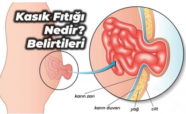 Uzun Süreli Öksürük ve Kronik Kabızlık Kasık Fıtığına Yol Açabilir