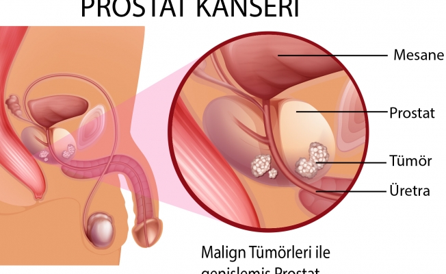 Prostat Problemi Yaşayan Erkeklere Holep Tedavisi!