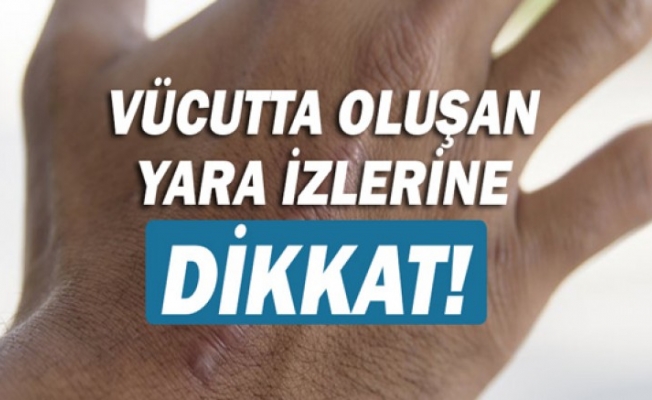 Vücutta Oluşan Yara İzlerine Dikkat! Yara İzi Nasıl Geçer?