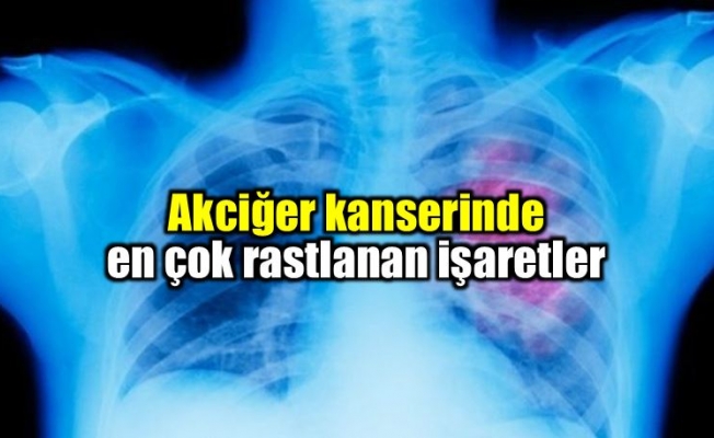 Akciğer Kanserine yakalanan 41 bin kişiden biri siz olmayın