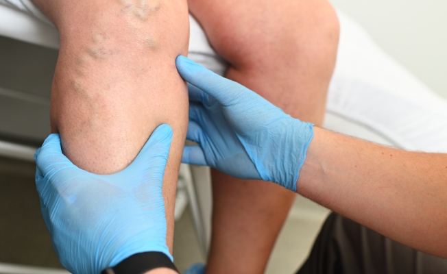 Günlük yaşam alışkanlıkları Varis riskini artırıyor